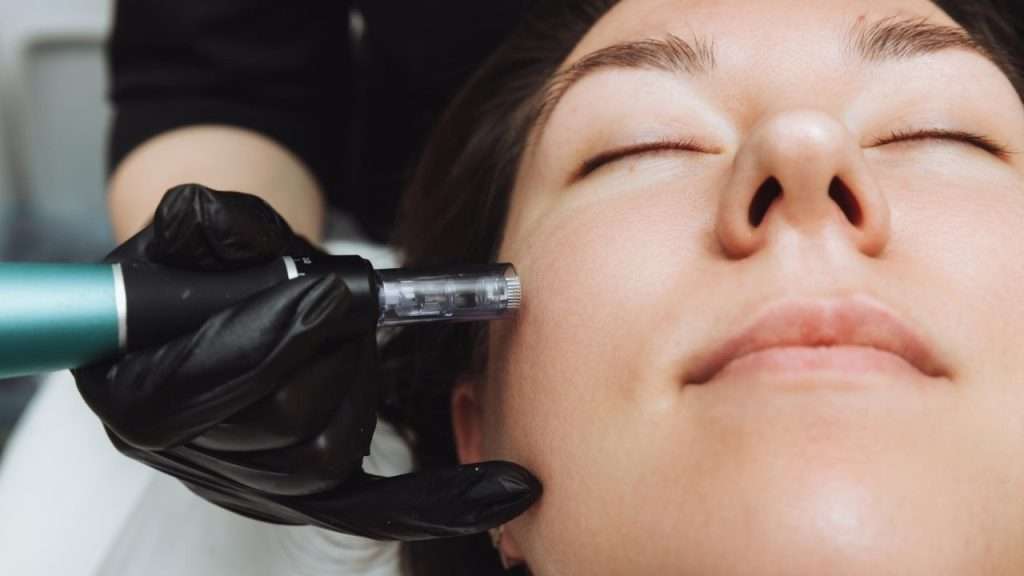 does microneedling hurts