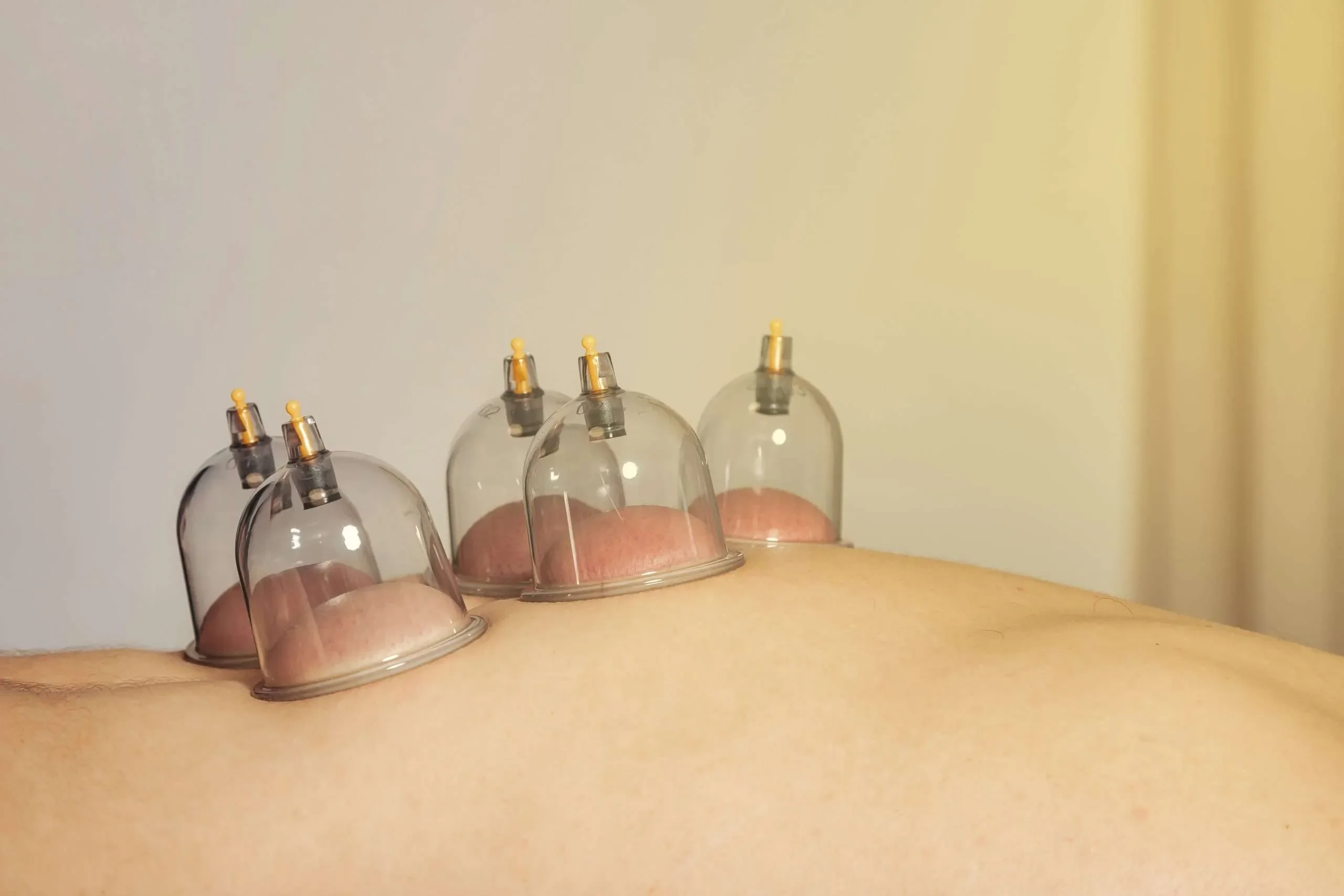 Best Cupping Therapy in Park Ridge, IL | Hijama in Chicago