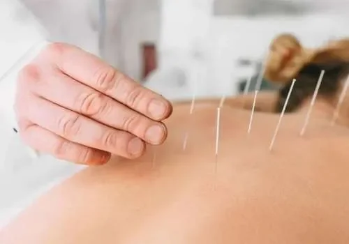 Chinese Acupuncture Therapy in Chicago & Park Ridge